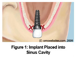 sinusLift_figure011